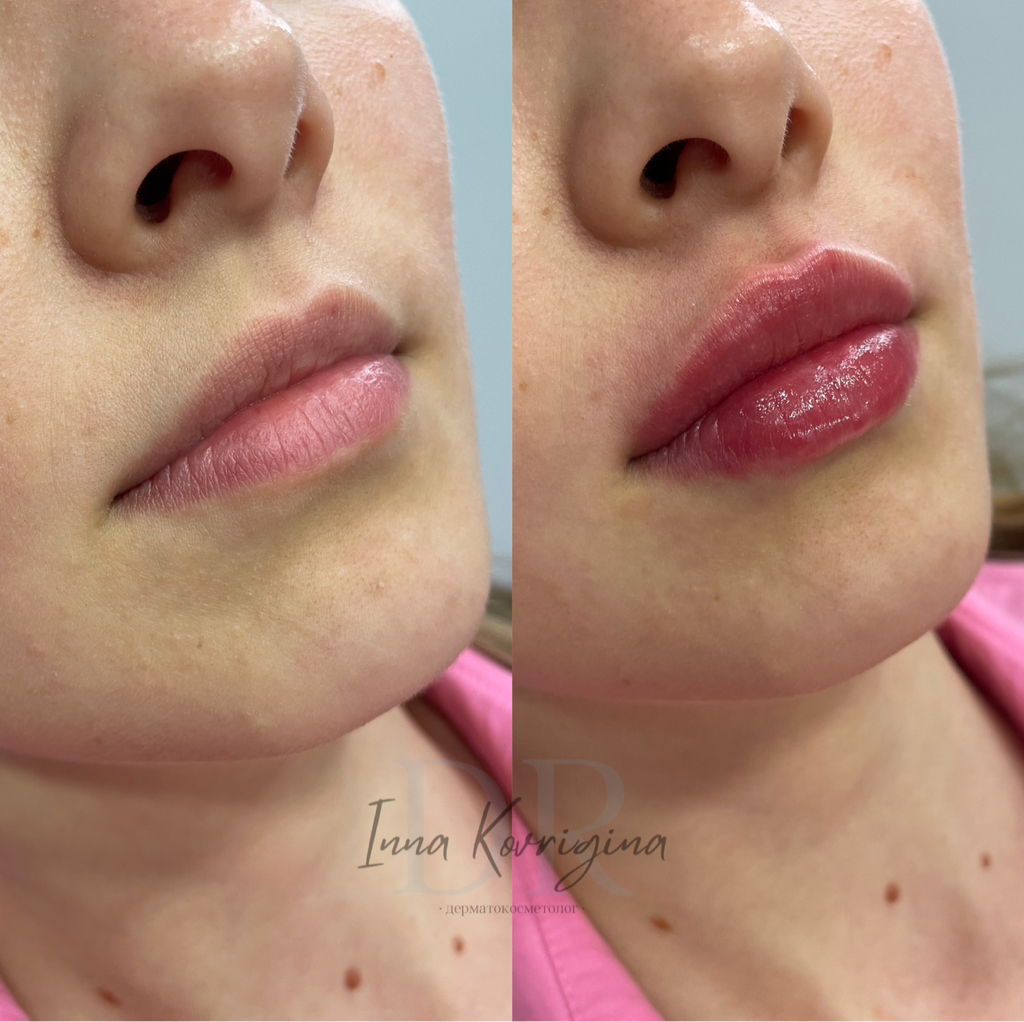 Контурная пластика губ Stylage M 1 мл