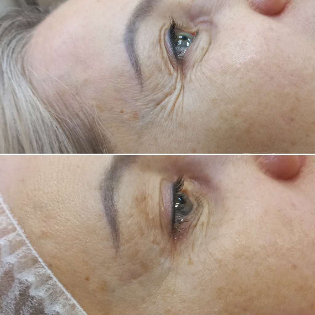 МЕЗОТЕРАПИЯ зона вокруг глаз