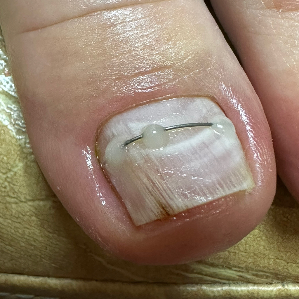 Ортониксия. Титановая нить. Вросший ноготь