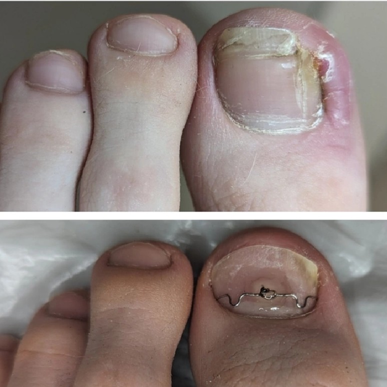 Безоперационное удаление вросших ногтей: первичный прием