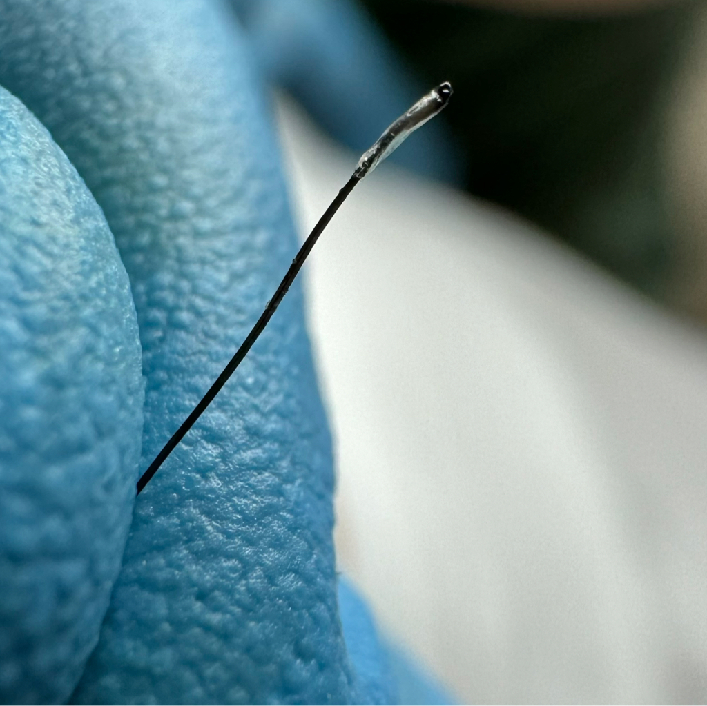 Электроэпиляция