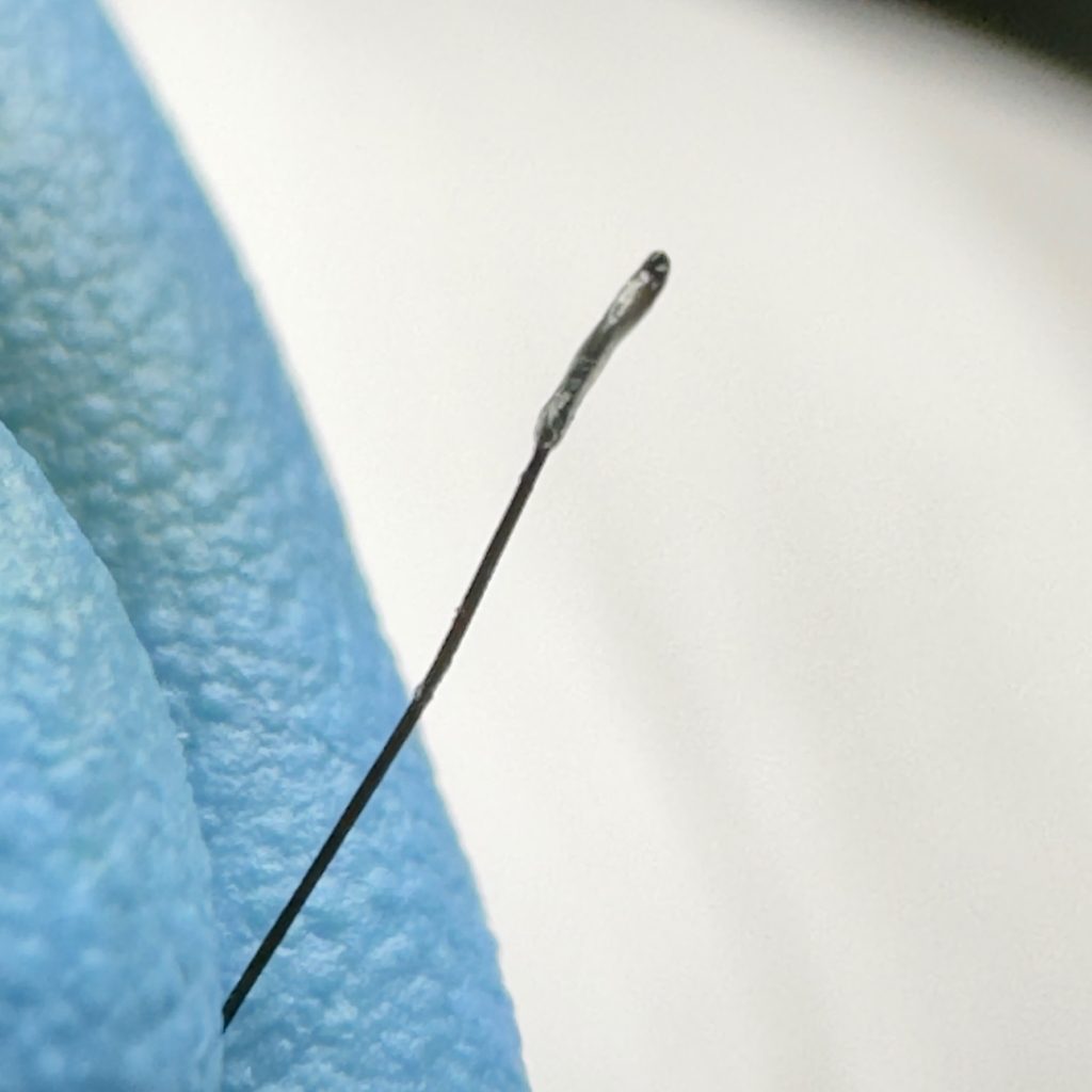 Электроэпиляция