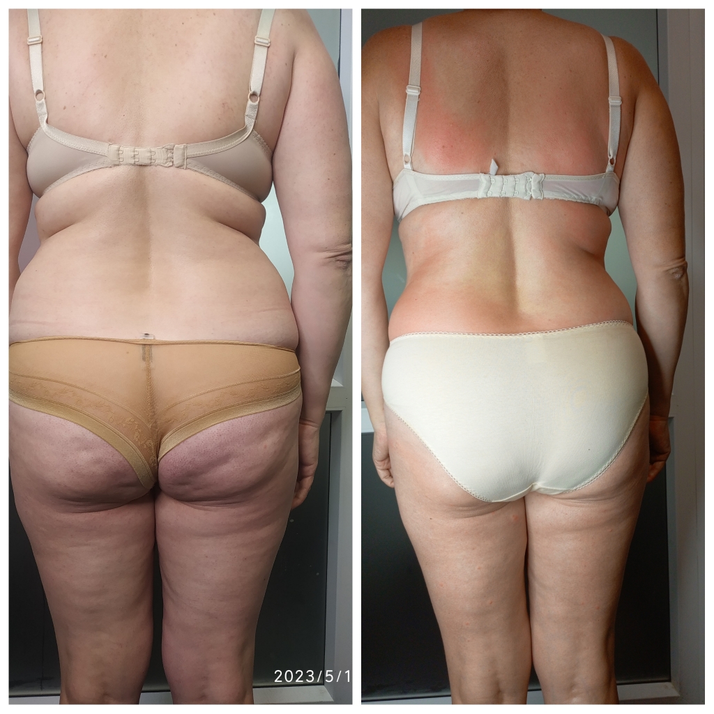 ваккумный массаж (30 минут)