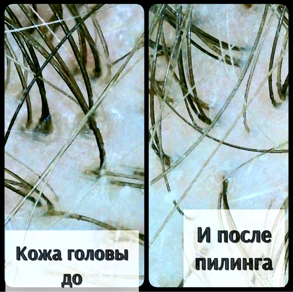 Процедура против перхоти/ жирной кожи головы/ выпадения