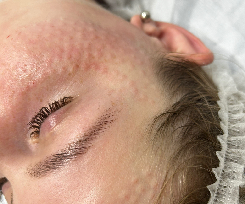 Мезотерапия лицо