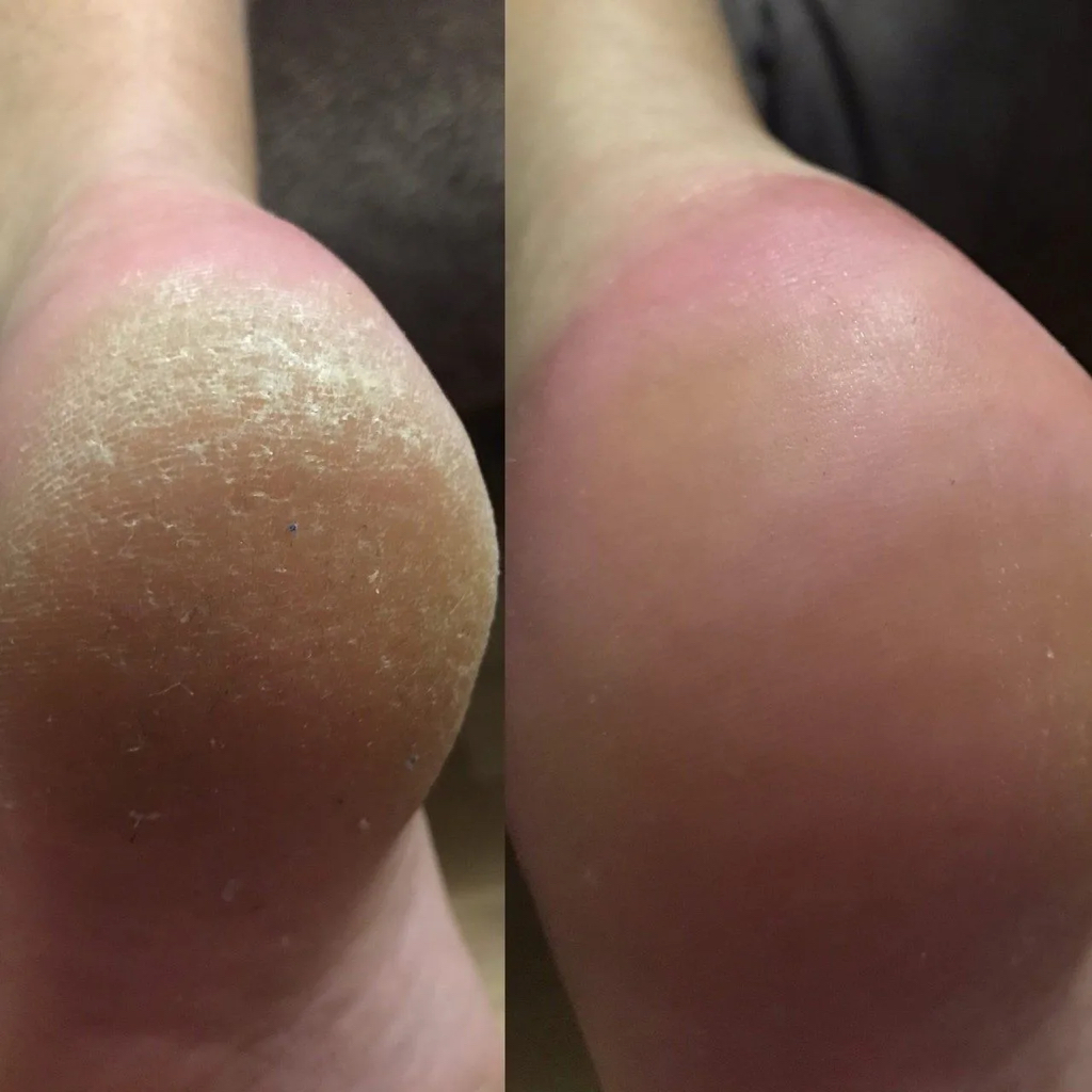 Обработка стопы