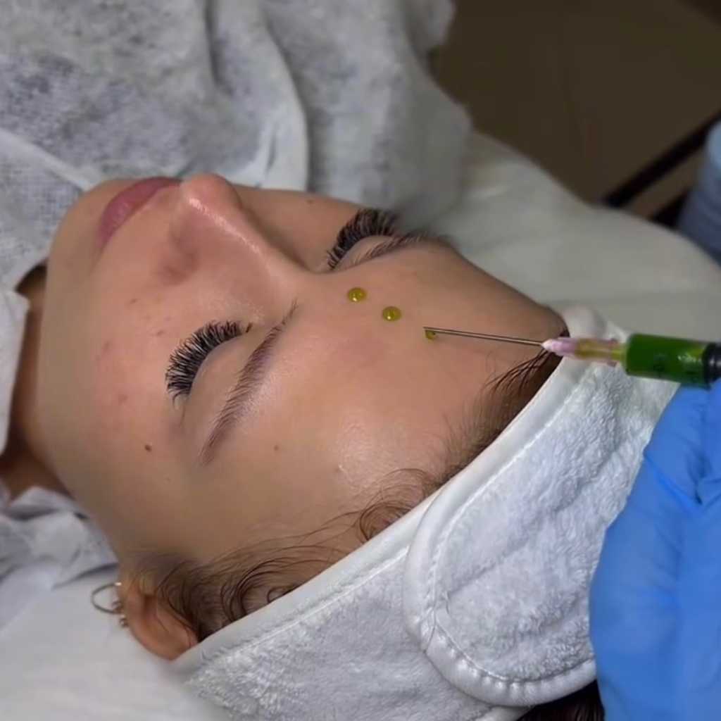 Комбинированное очищение кожи лица «GIGI Acnon (акне)