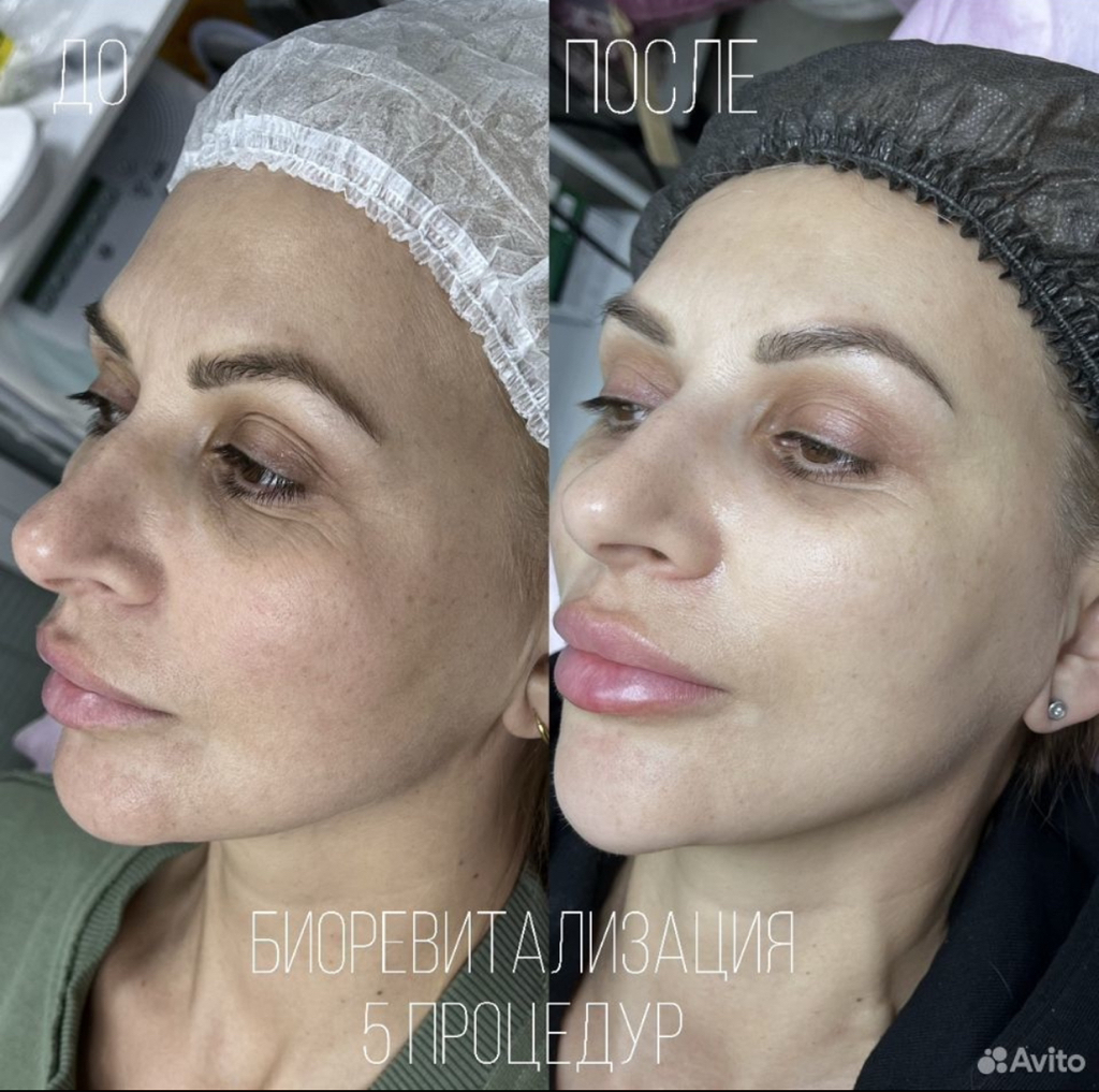 Биоревитализация