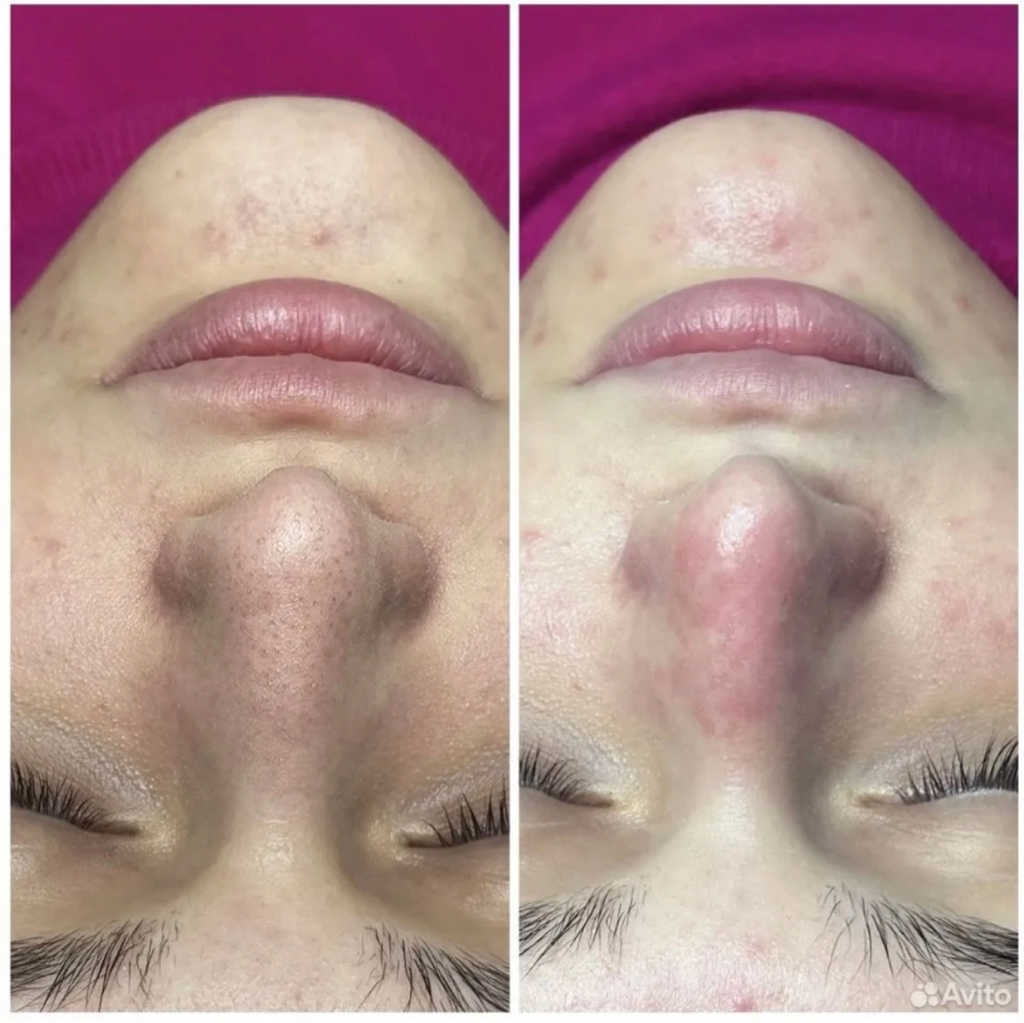 Комбинированная чистка лица