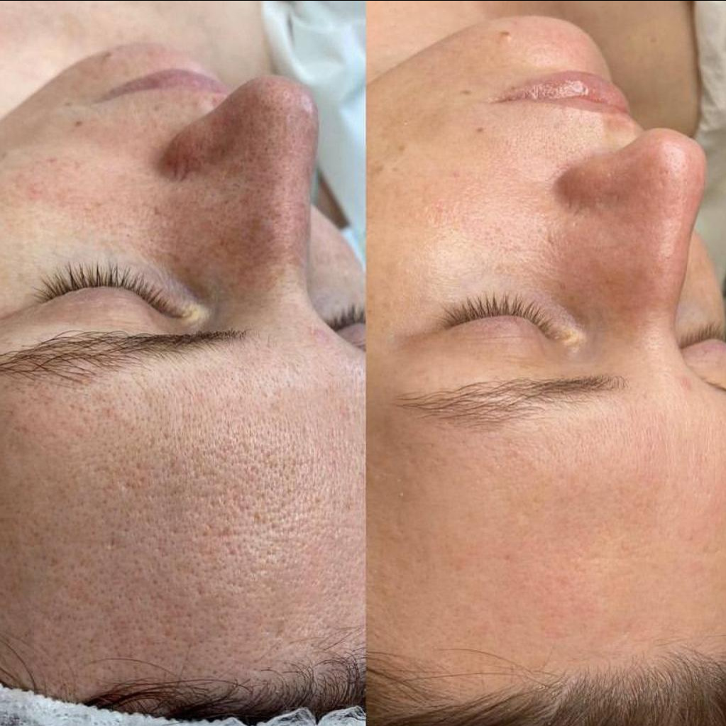 Антикомедонная чистка лица