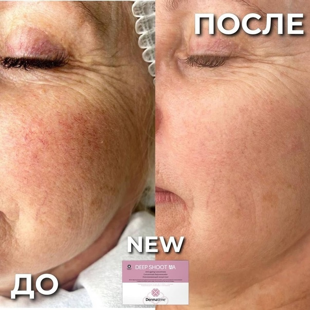 Интенсивное омоложение и ревитализация кожи лица - DEEP SHOOT A4  DERMATAIME Испания