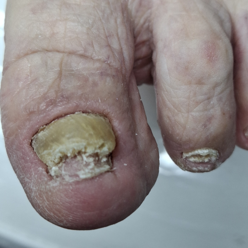 Онихомикоз-грибок