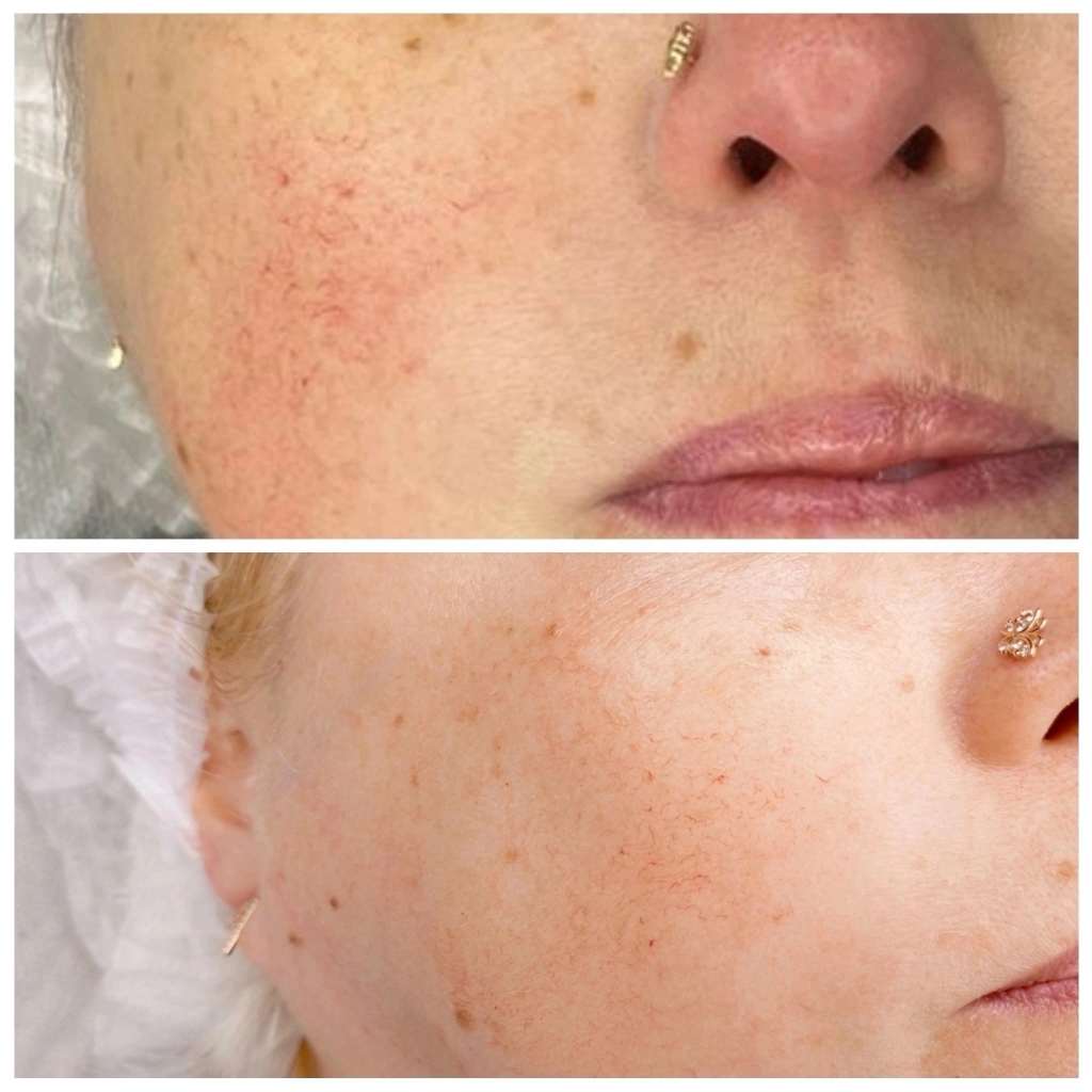 фракционная мезотерапия(без инфекции)