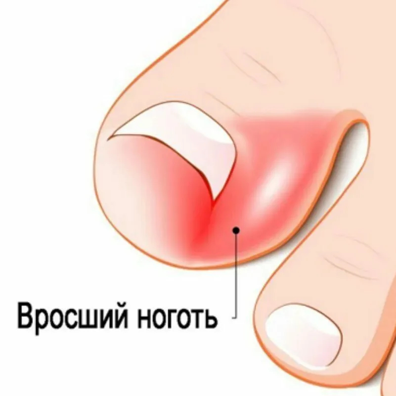 Вросший ноготь (извлечение вросшего сегмента с воспалением)