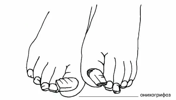 Обработка онихогрифоза