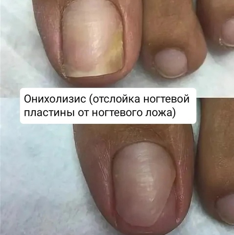 Обработка онихолизиса