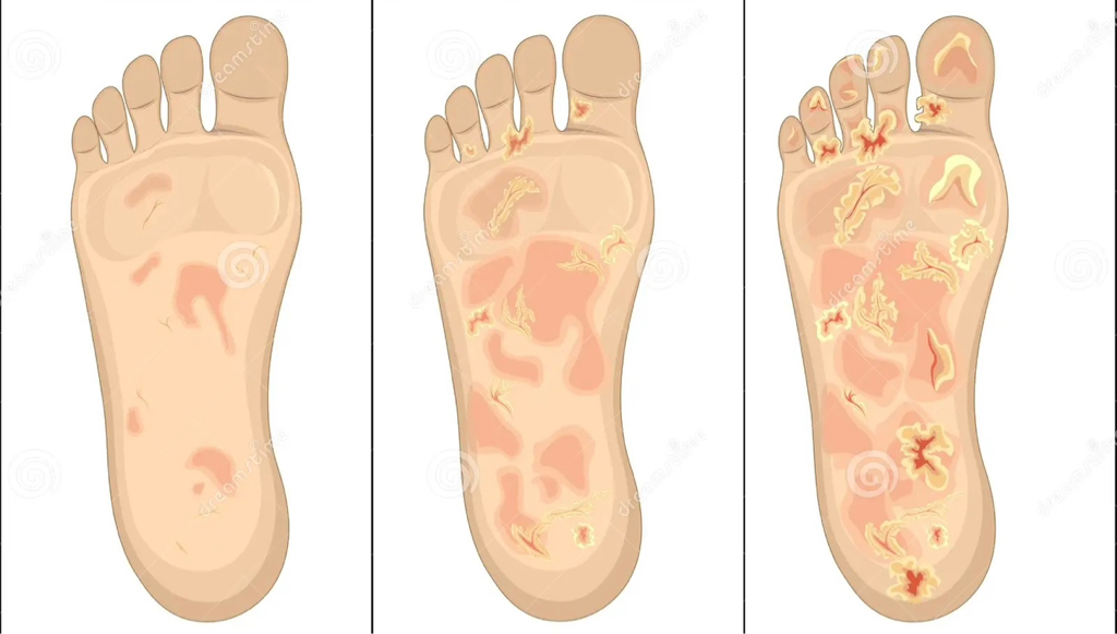 Обработка стоп с дерматомикозом