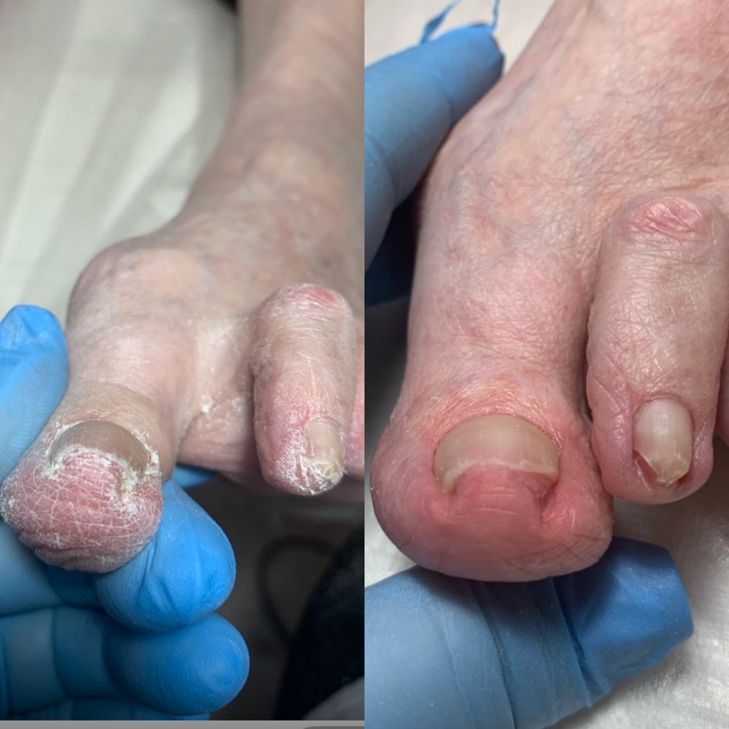 Работа с грибковым поражением ногтей