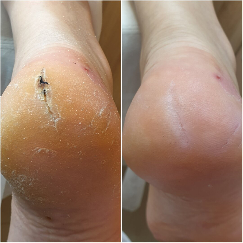 Обработка трещин