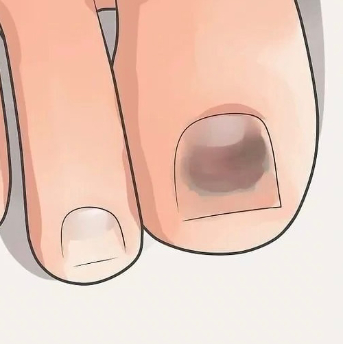 Обработка гематомы