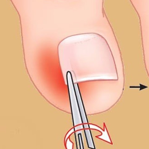 Вросший ноготь (извлечение сегмента без воспаления)