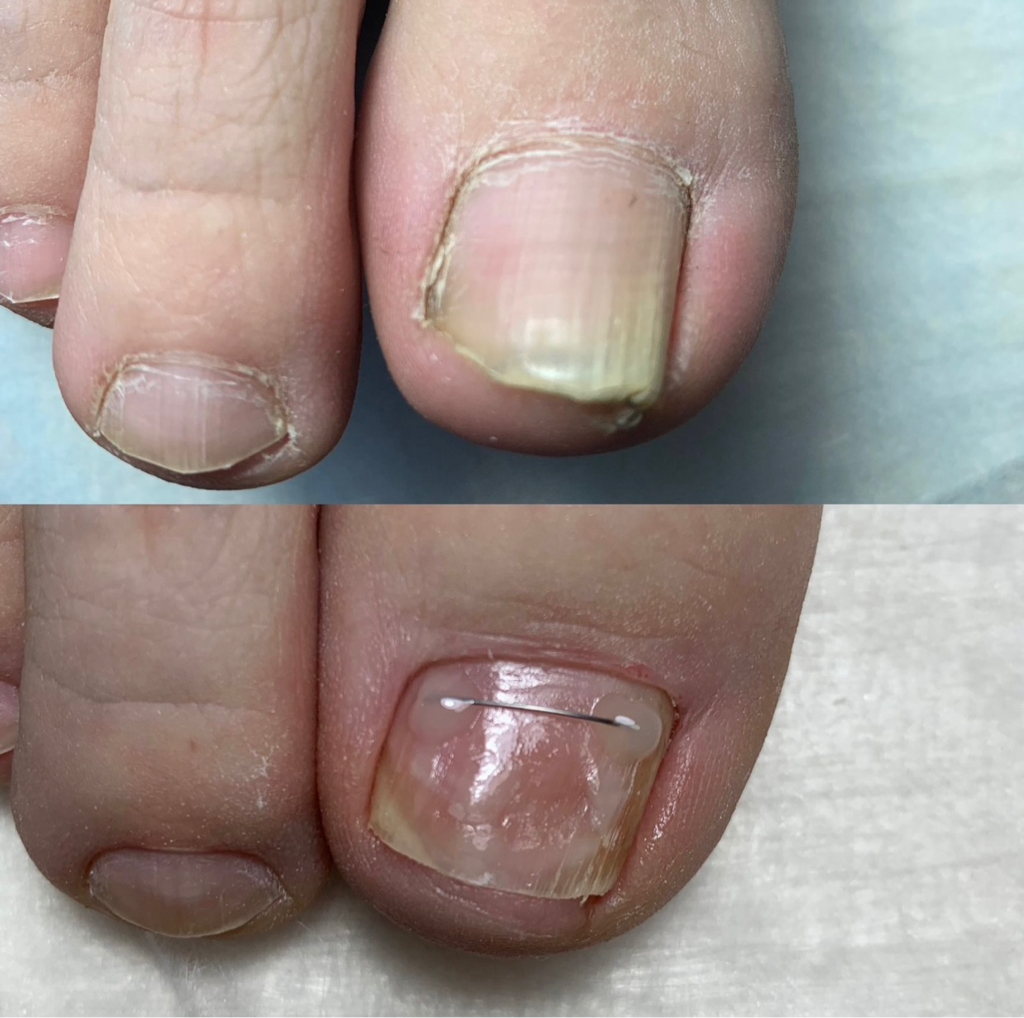 Установка коррекционной системы «Титановая нить» 1 ноготь