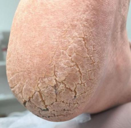 Педикюр с осложнением кожи (гиперкератоз)