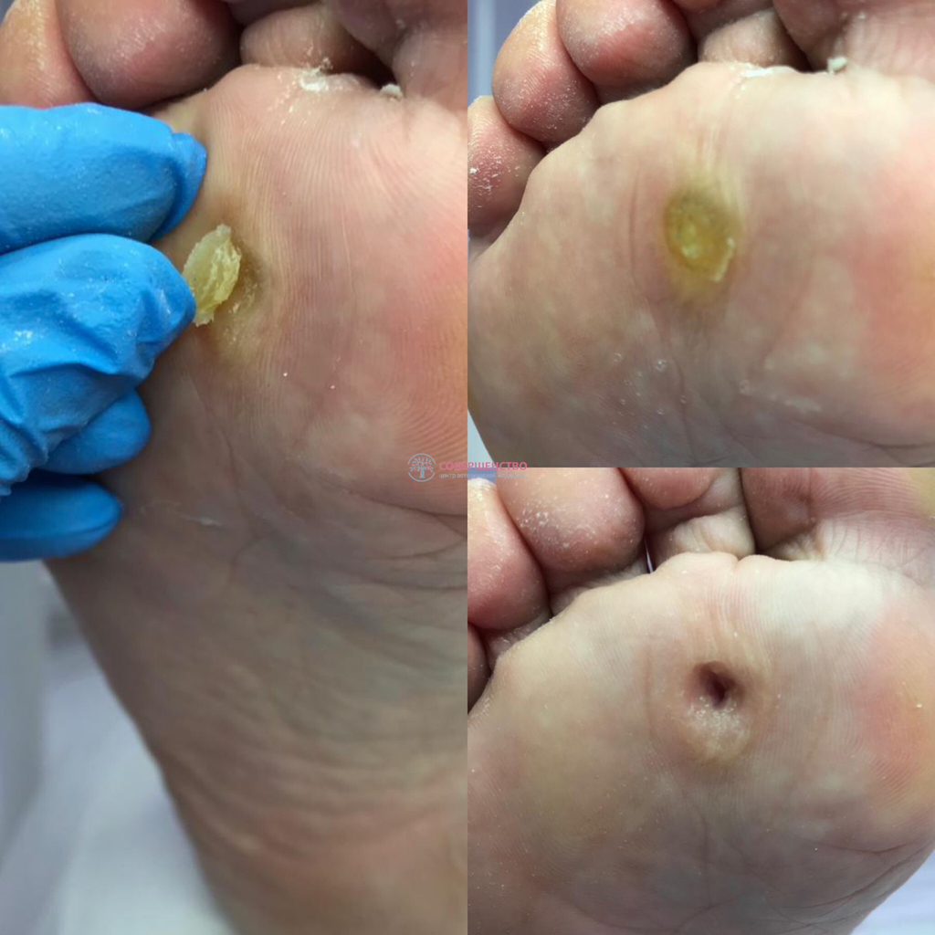 Обработка стержневой мозоли