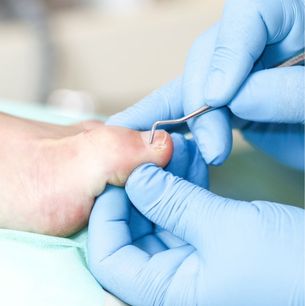 Обработка деформированного (врастающего) ногтя