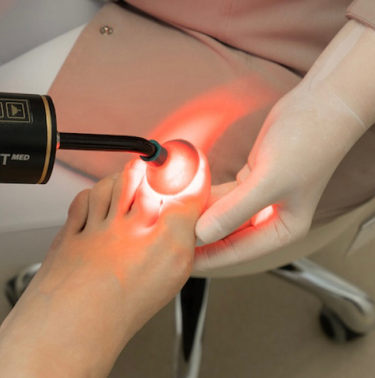 Фотодинамическая обработка ногтей