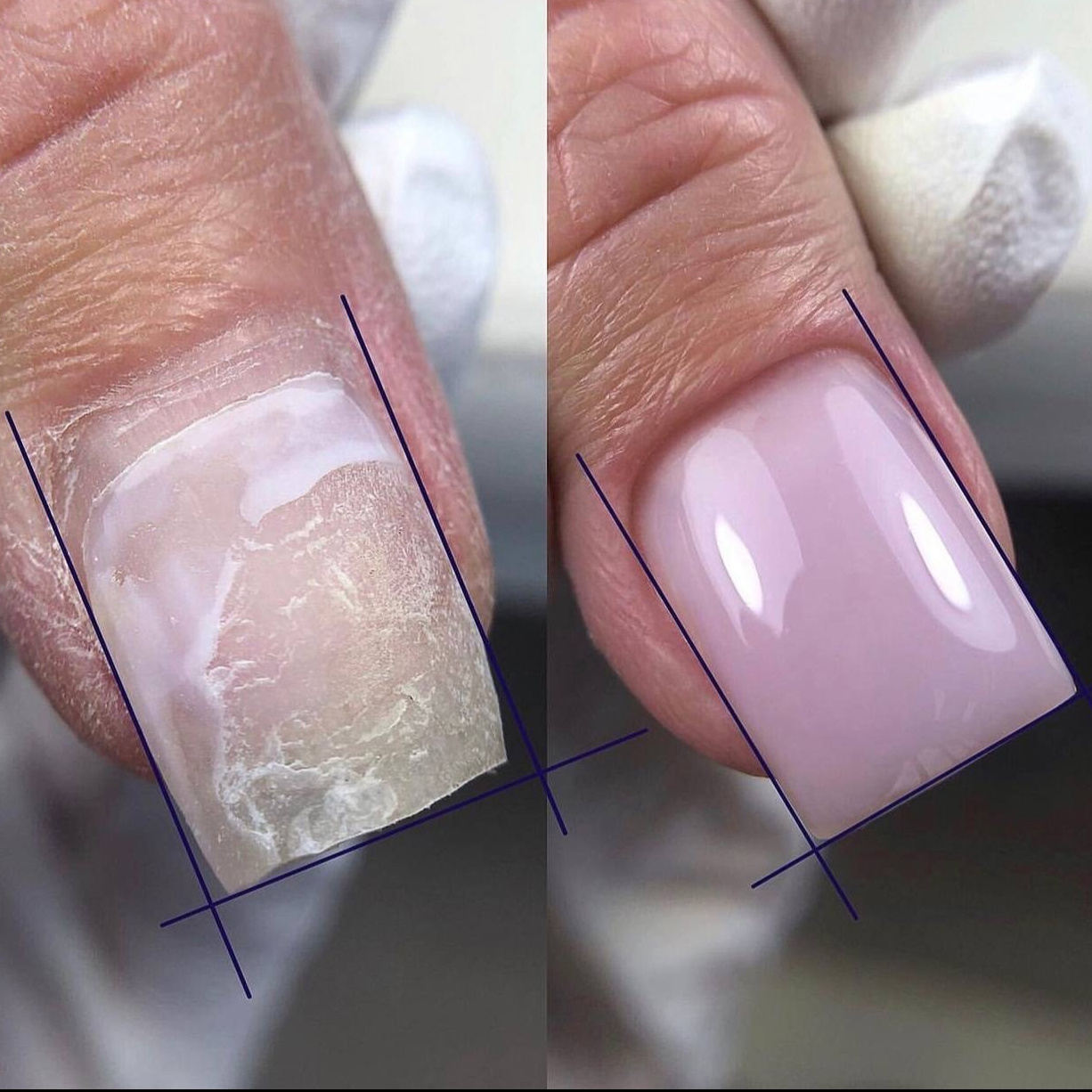 Укрепление ногтей акригелем