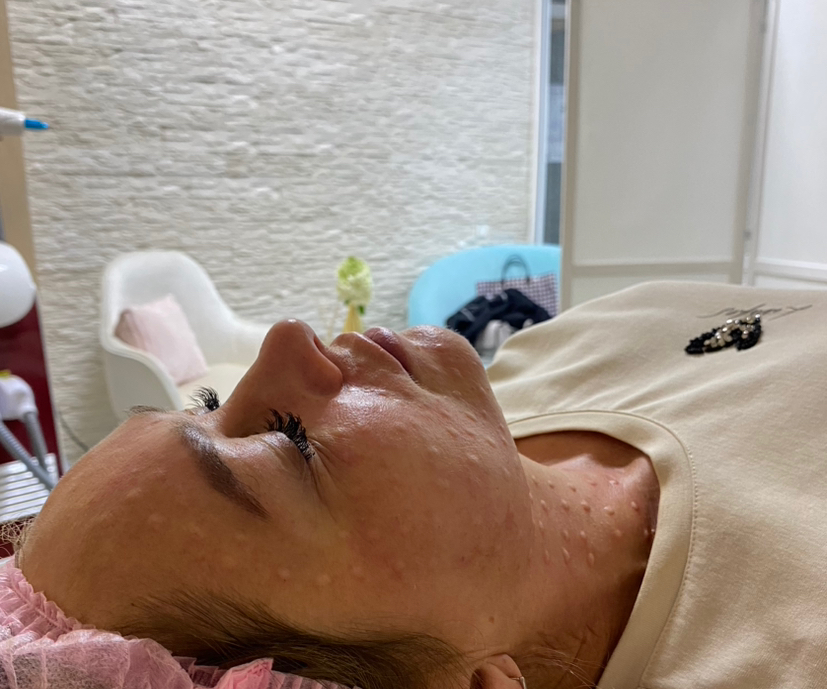 Биоревитализация