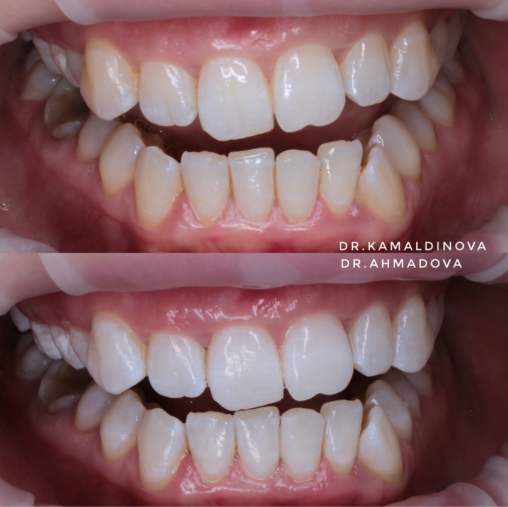 Отбеливание зубов