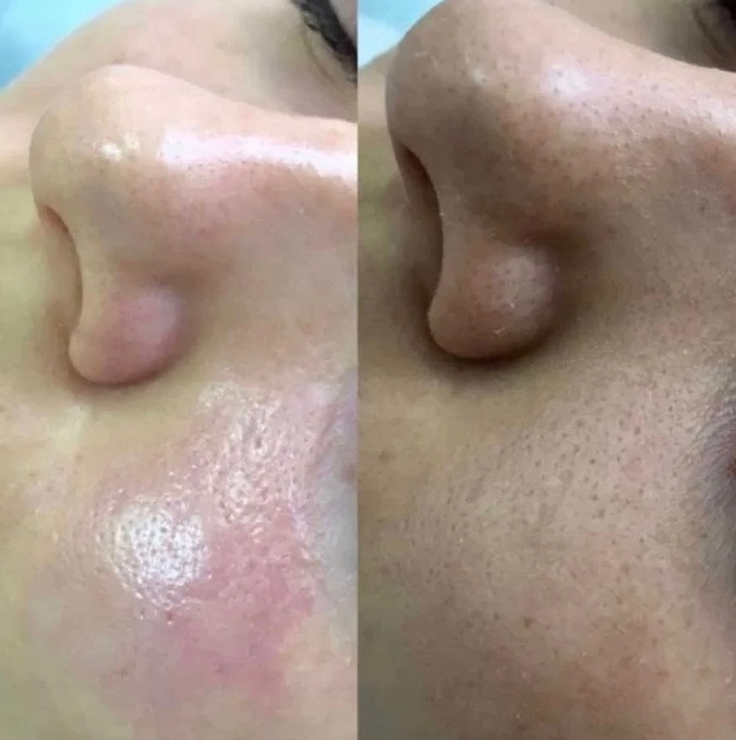 Комбинированная чистка лица