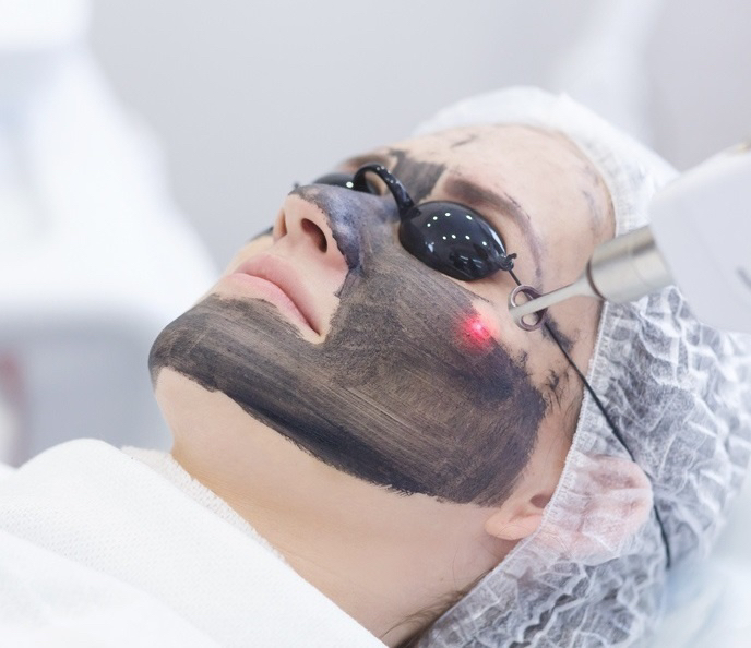 Карбоновый пилинг