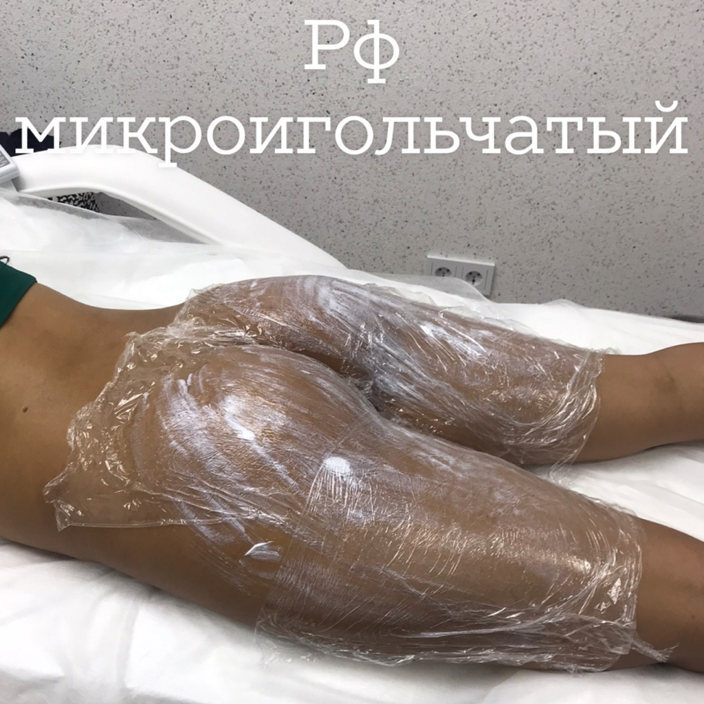 Rf микроигольчатый  Бедра При покупке абонемента-10%