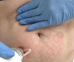 Rf микроигольчатый  Живот полностью При покупке абонемента-10%