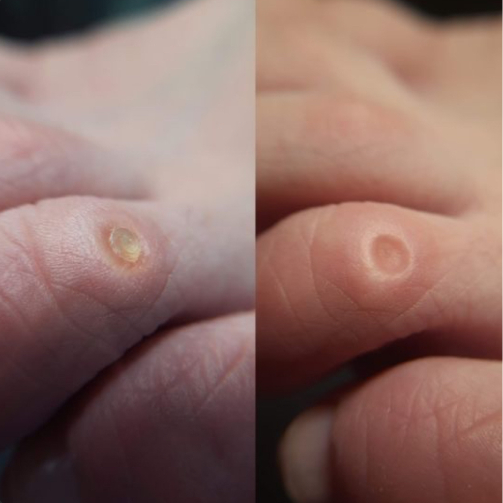 Удаление мозоли