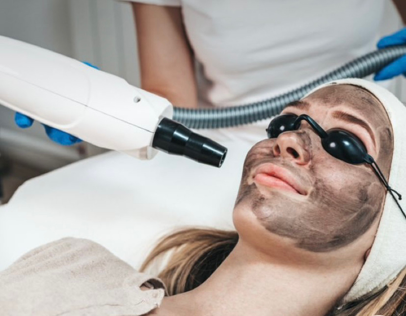 Карбоновый пилинг