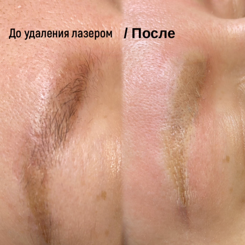 Лазерное удаление