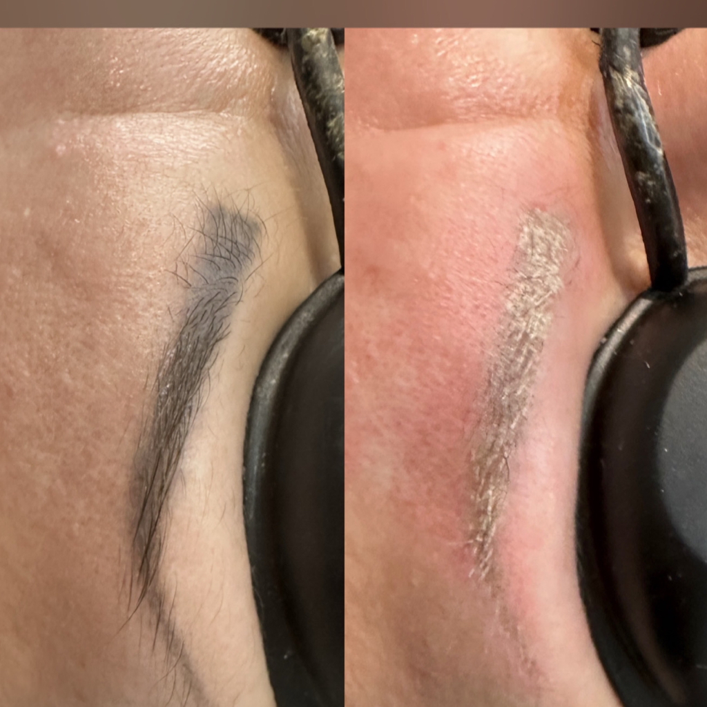 Удаление старого татуажа лазером