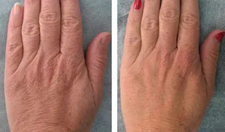 Rf микроиголчатый  Руки При покупке абонемента-10%