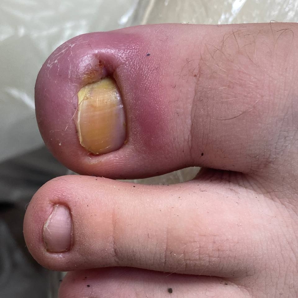 Коррекция вросшего ногтя