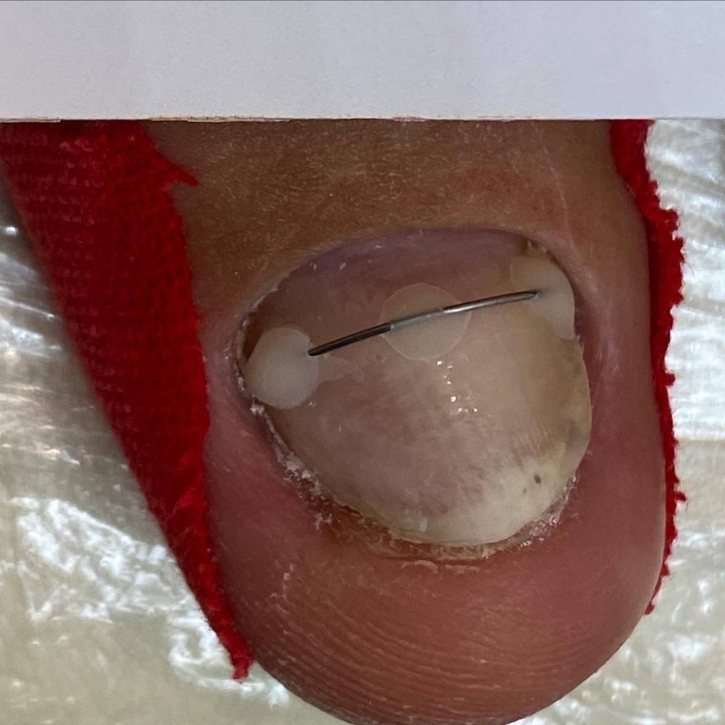 Установка титановой нити