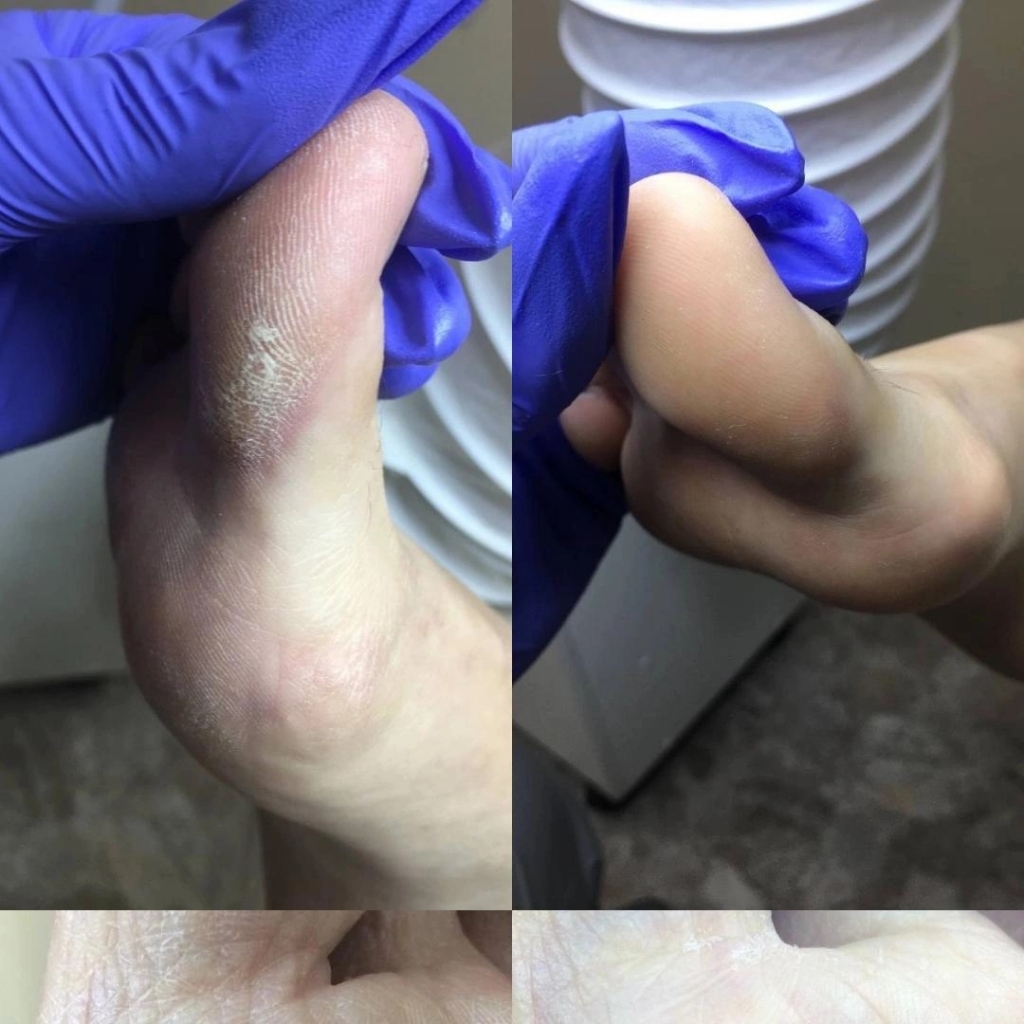 Аппаратная обработка мозолей