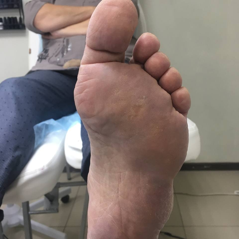 Аппаратная обработка стопы