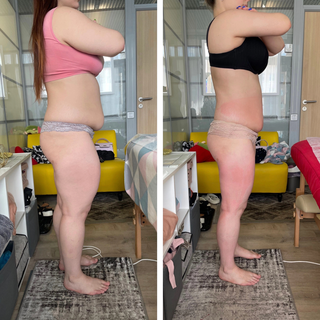 Антицеллюлитный массаж