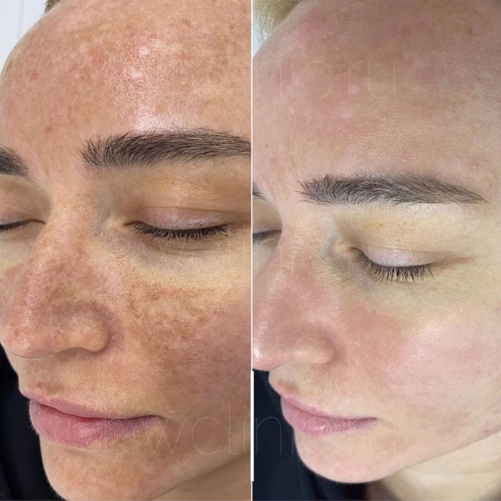 Карбокситерапия