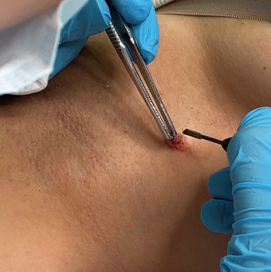 Удаление папилон кератом