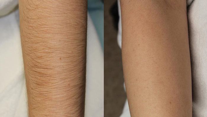 Депиляция рук